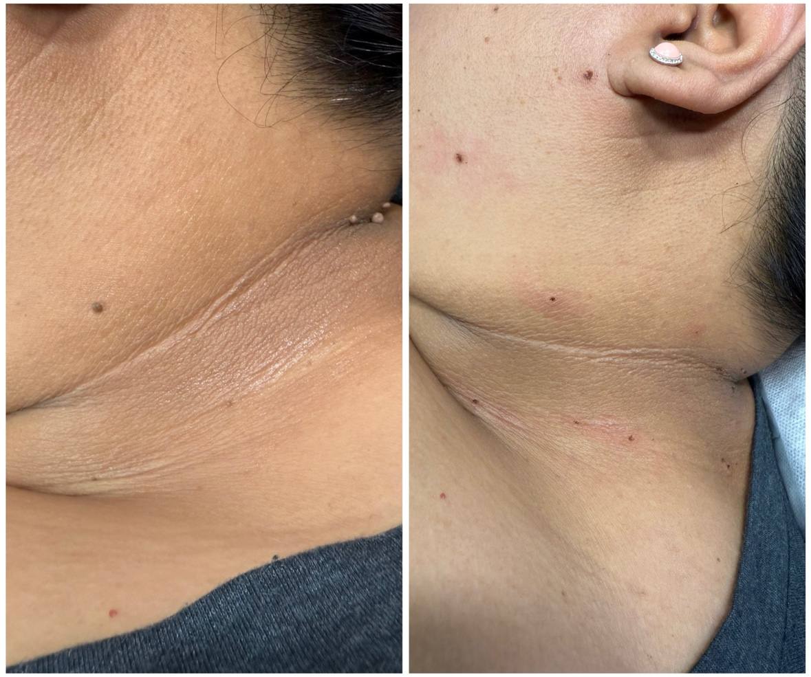 Skin treatment before and after Full Circle Beauty San Diego